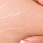 زيوت طبيعية لـ علاج الاسترتش مارك النساء في الفن