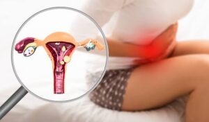  أعراض بطانة الرحم المهاجرة