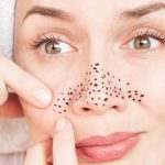 وصفة طبيعية لعلاج الرؤوس السوداء