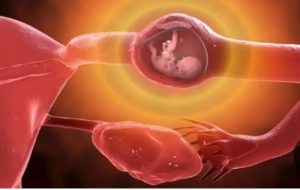 الحمل خارج الرحم.. الخطر الصامت بين الطب والواقع الصحي في مصر والعالم صحة المرأة