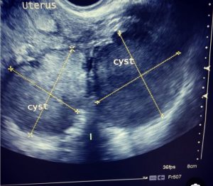 الحمل خارج الرحم.. الخطر الصامت بين الطب والواقع الصحي في مصر والعالم صحة المرأة